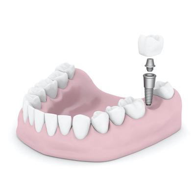 An illustration of a dental implant on a crown at CFS Dental