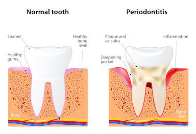An illustration of periodontal disease in Oatley, NSW.
