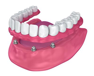 All-on-4® implant dentures in oatley nsw