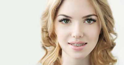 Lady smiling with braces on her teeth in Oatley, NSW