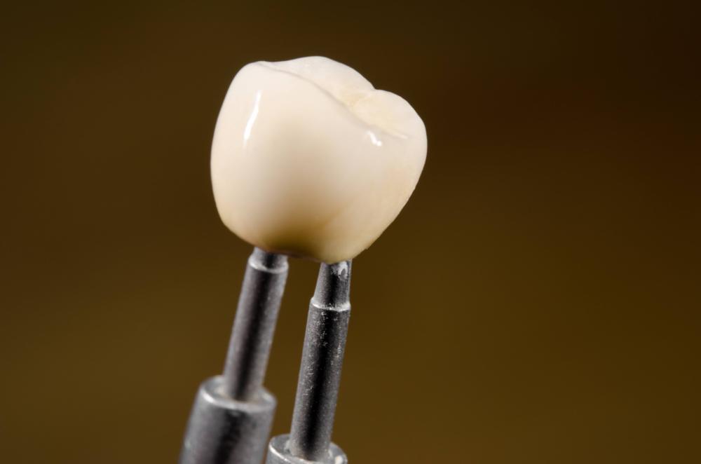 Picture of dental crown at CFS Dental