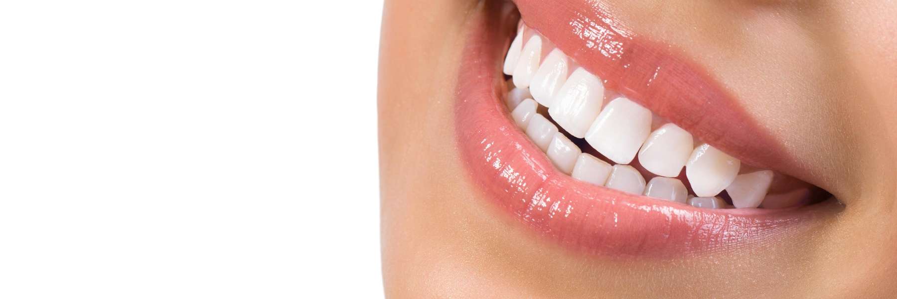 Lady's teeth after professional whitening in in Oatley, NSW