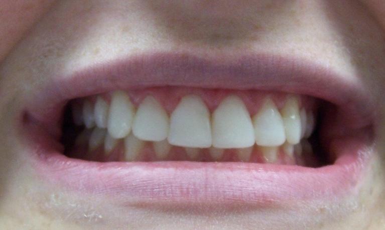 Preventative-After-Image